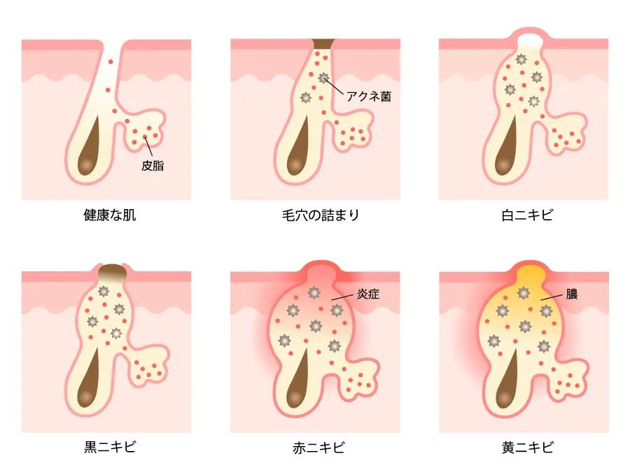 健康な肌とニキビの種類を説明する図