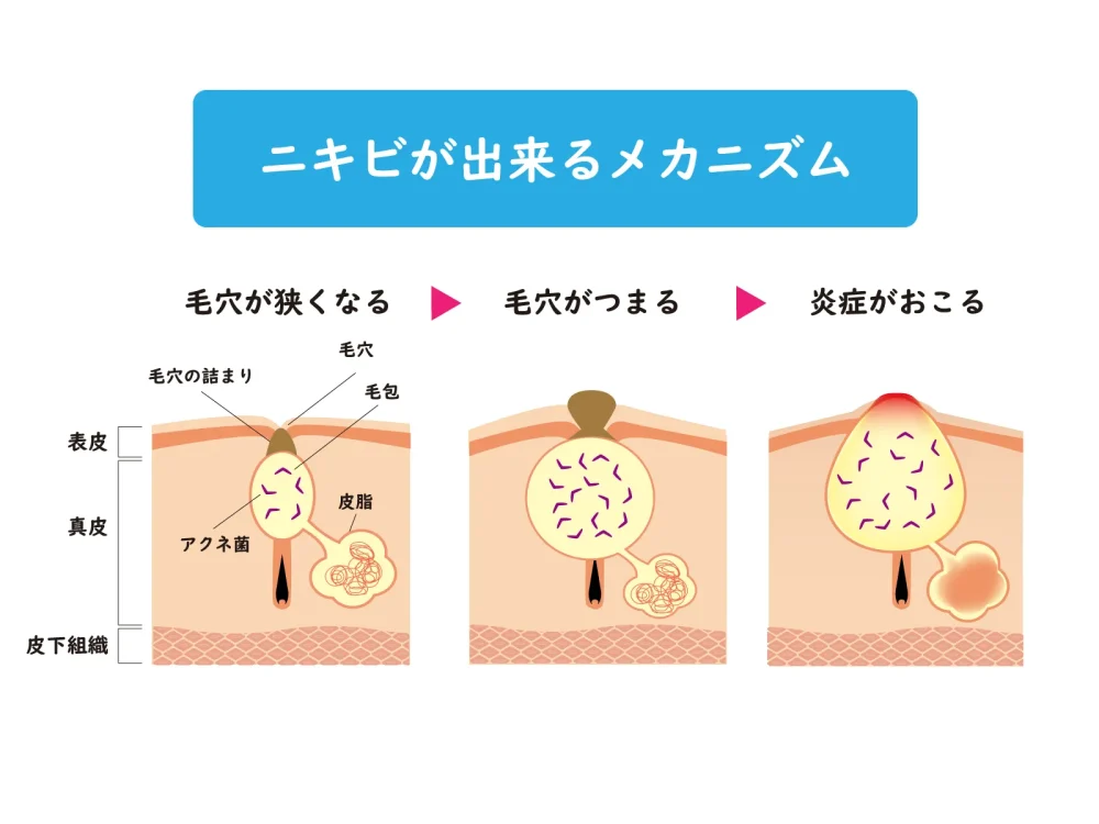ニキビができるメカニズムを説明した図